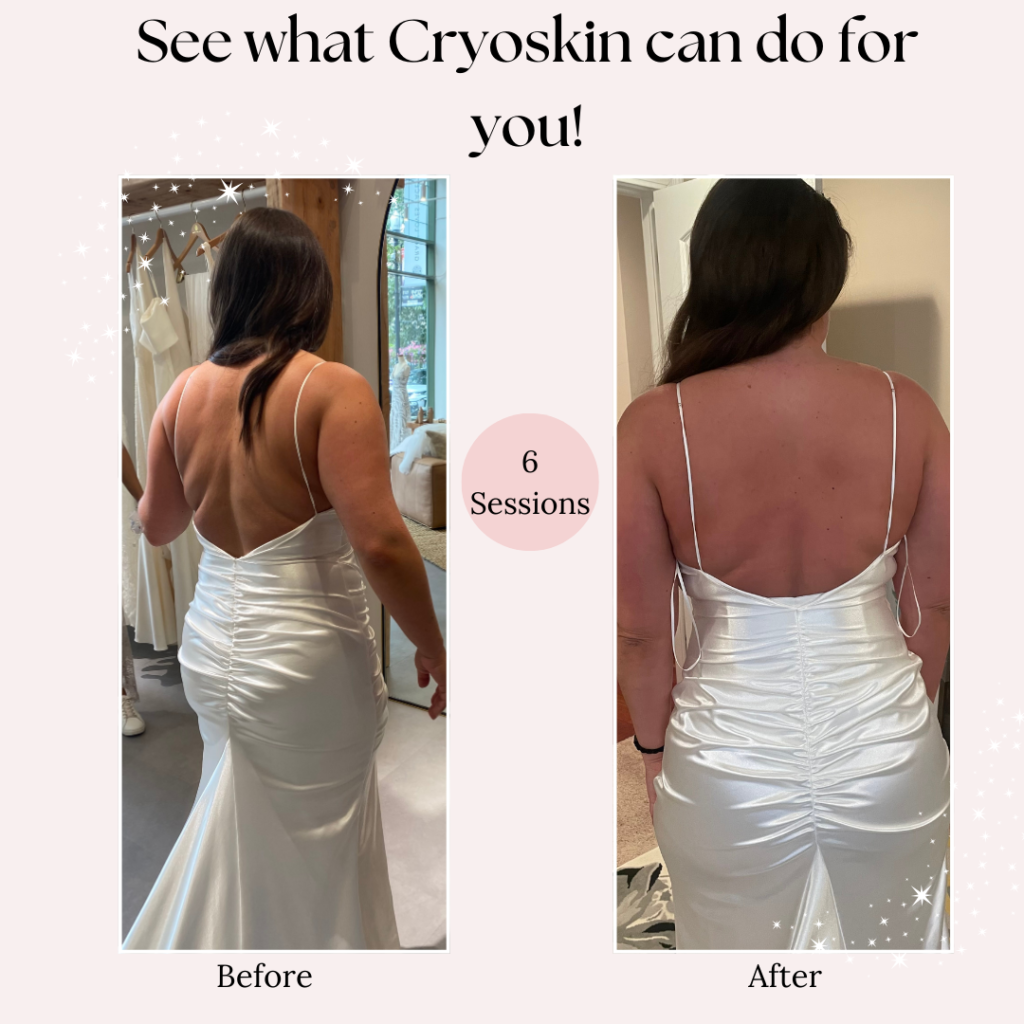 Cryoskin Body Sculpting 101: How It Works and What To Expect